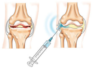 Гонартроз (артроз коленного сустава): лечение